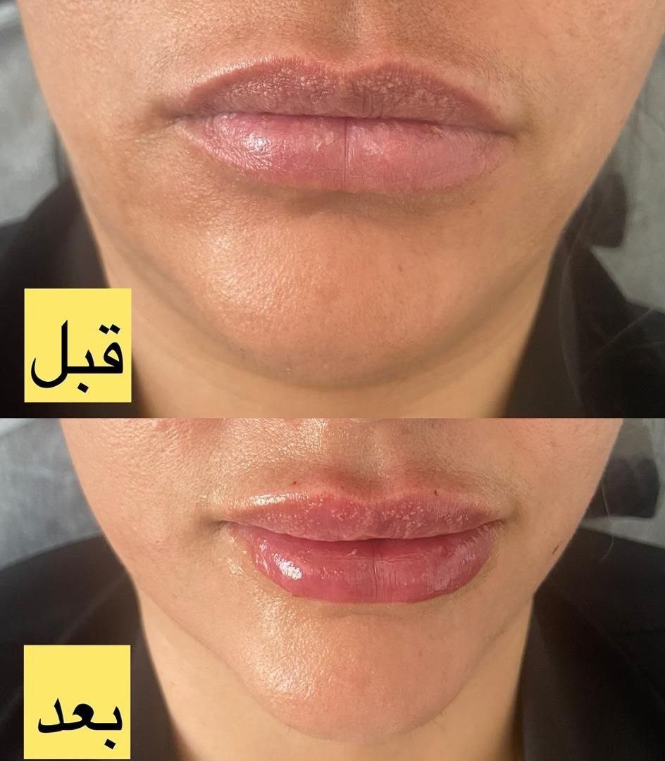 قبل و بعد تزریق